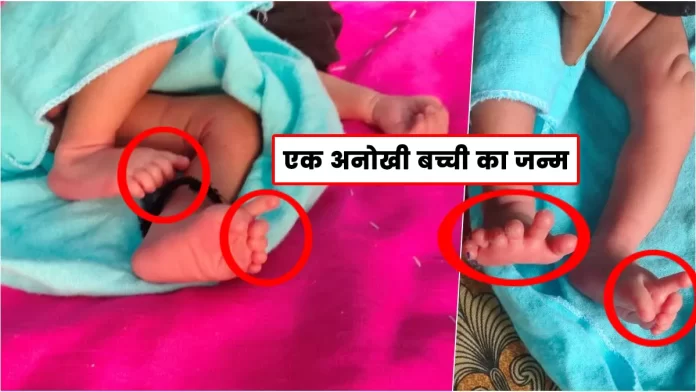 girl was born in Rajasthan with 26 fingers in her hands and feet
